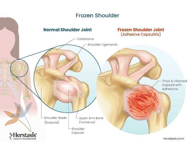 Frozen shoulder rehabilitation diagram at Munir Hafeez Medical Center Gujranwala