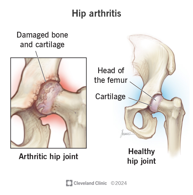 Hip arthritis rehabilitation diagram at Munir Hafeez Medical Center Gujranwala